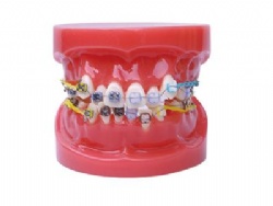 HG-B1-02 Ortho Metal&Ceramic Bracket Model