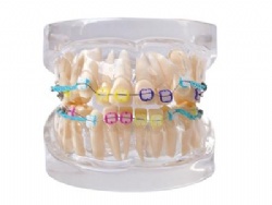 HG-B2-03 Ortho Ceramic Bracket Model