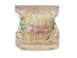 HG-B8-03 Ortho Ceramic Bracket Model