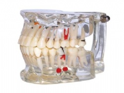 HG-C2 Edentulous Pathology Model