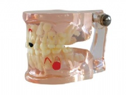 HG-C7 Clear Mixed Age Model with Caries