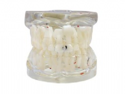 HG-C12 Clear Extraction Model with Caries