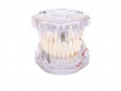 HG-C15 Restration with Implant(Clear, Blue, Orange, Pink, Yellow are available)