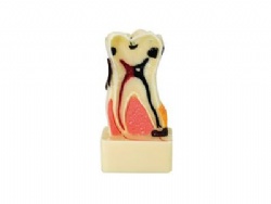 HG-C17 4 Times periodontal disease