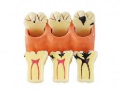 HG-M1 4Times Caries Disassembling Model