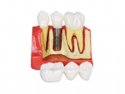 HG-M3 4 Times Implant Model