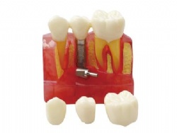 HG-M3-01 4 Times Implant Model