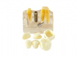 HG-M3-02 4 Times Implant Model