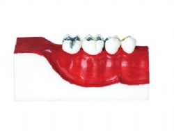 HG-M9 Decomposition model of right posterior tooth tissue