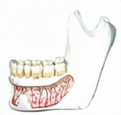 HG-P1 Mandible with Hinge Buccal