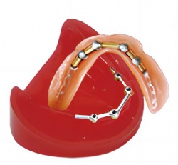HG-T9 Implant With Clip Attachments