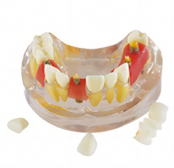 HG-T11 Implant Model