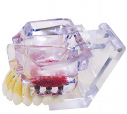 HG-T14 Implant Model